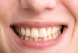 What Causes Yellow Teeth Treatments for Stains