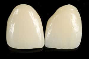 Pveneers