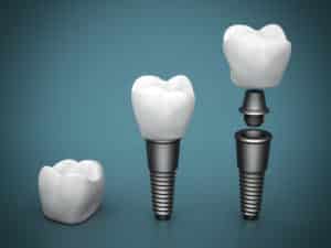 dentalimplantpiecebypiece