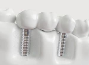 implant bridge