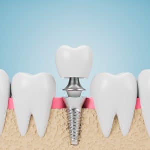 dental implant restoration