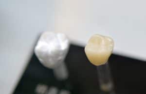 ankeny dental crown