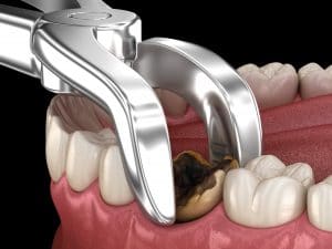 tooth extraction ankeny