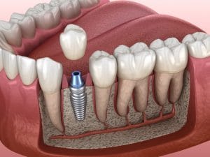 ankeny dental implant