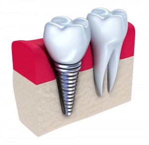 cross section of dental implant
