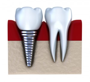 dental implant ankeny
