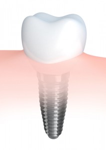 dental implant 4