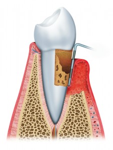 gum disease 2