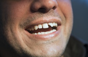 Smiling man with a chipped tooth