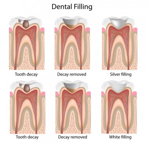 fillings1